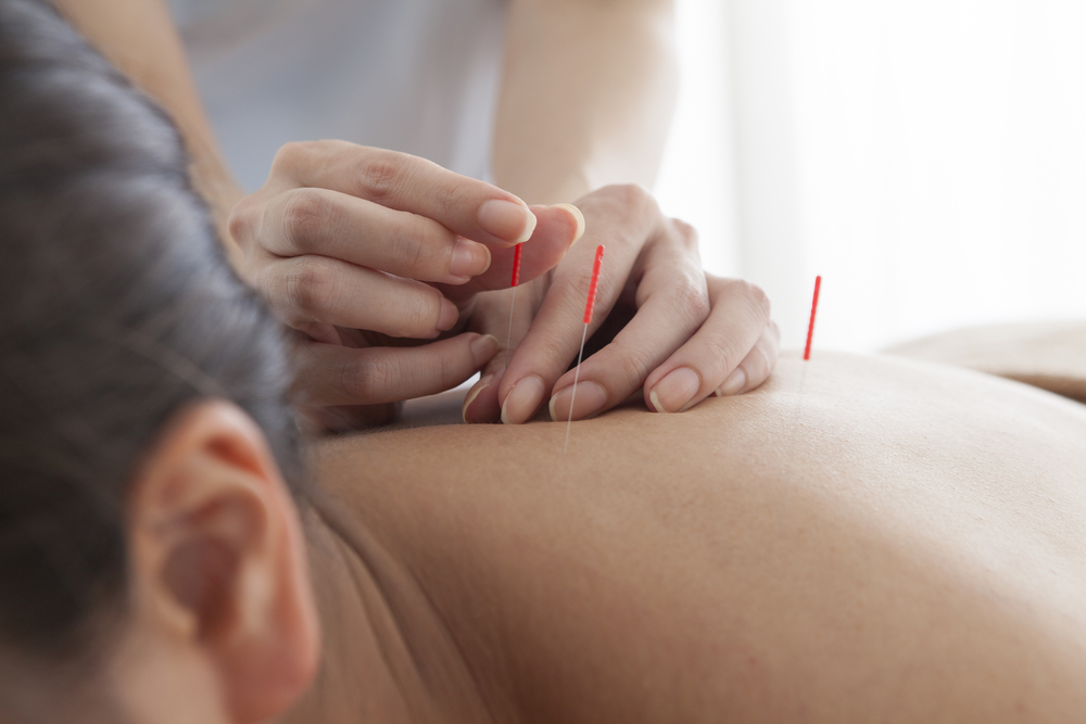 Dry Needling in Irving, TX Dry Needling in Irving, TX